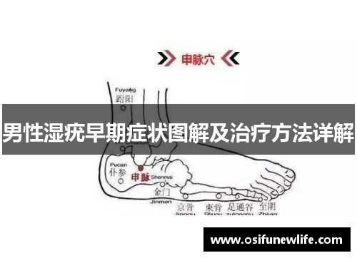 男性湿疣早期症状图解及治疗方法详解